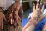 how to get rid of black henna scars, black henna side effects, henna tattoo cause aussie woman to almost lose her hand, Tattoos