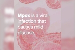 mpox break down, mpox news, mpox emergency again, Sweden