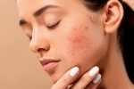 home remedies, skin care, 10 ways to get rid of pimples at home, Acne